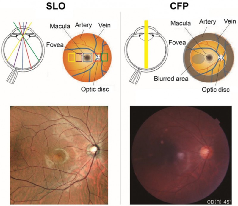 Nghiên cứu so sánh Công nghệ SLO và Chụp ảnh màu đáy mắt thông thường